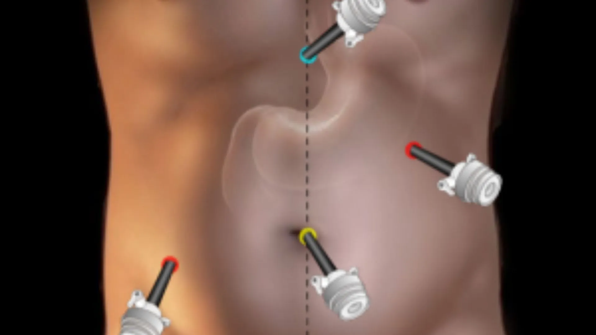 Cirurgia de Vesícula | Dr. Rodrigo Naves | Cirurgião Gastroinstestinal