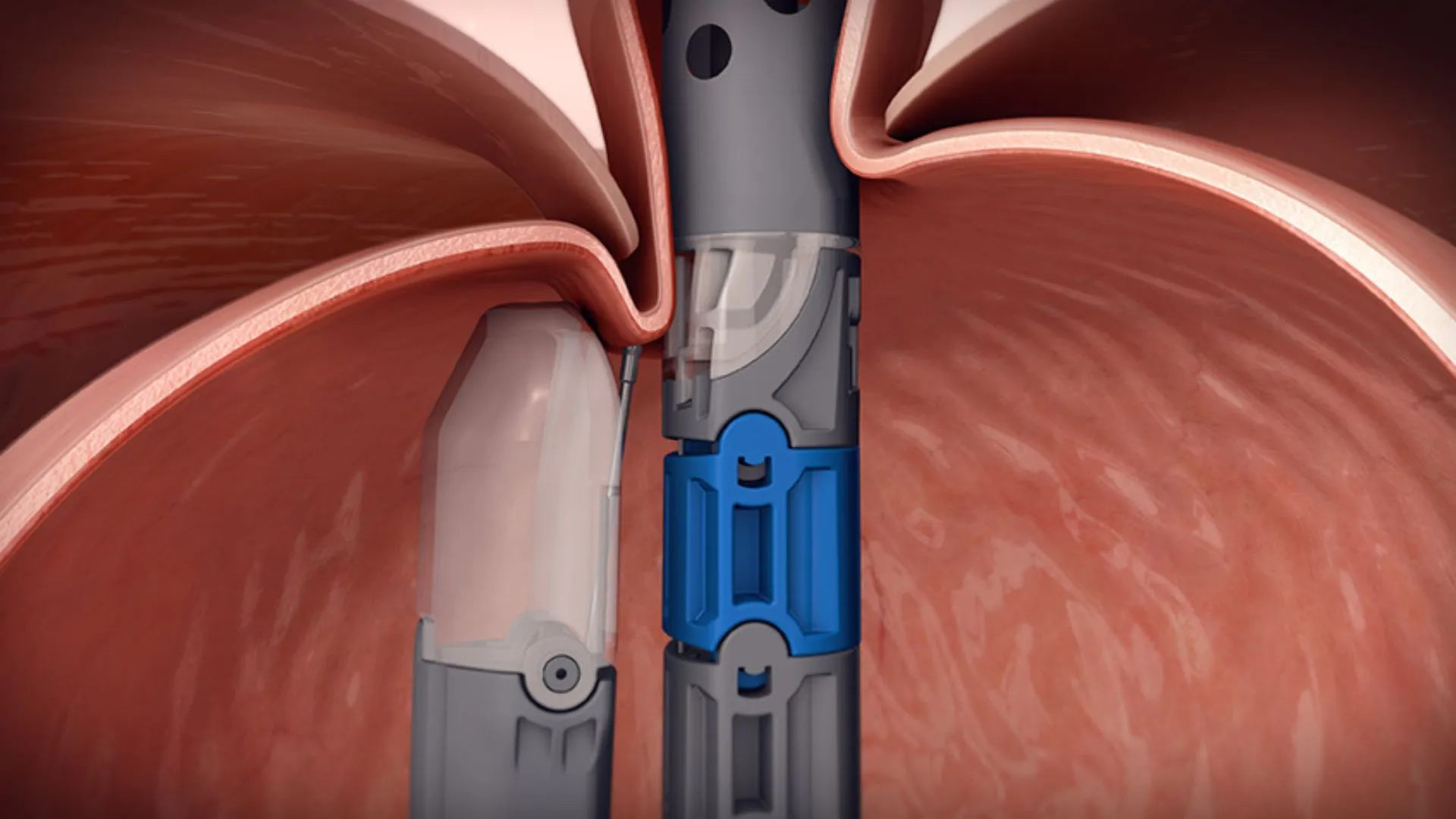 Cirurgia do Refluxo | Dr. Rodrigo Naves | Cirurgião Gastroinstestinal